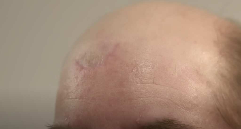 Dr Pimple Popper patients forehead left with no scars