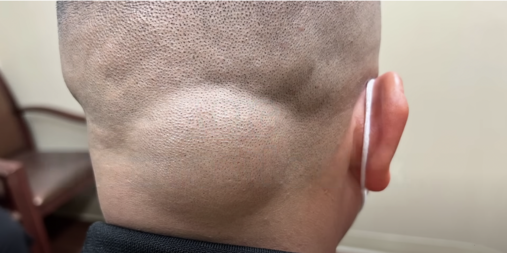 Dr Pimple Popper patient huge neck lipoma