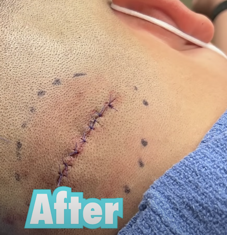 Dr Pimple Popper after photo of neck lipoma