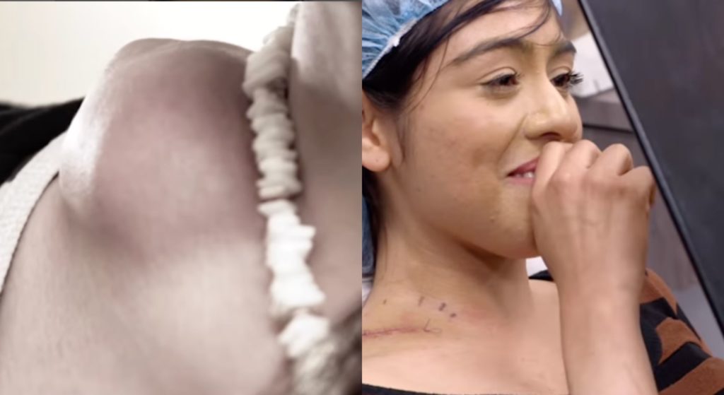 Dr Pimple Popper before and after neck cyst patient smiling after