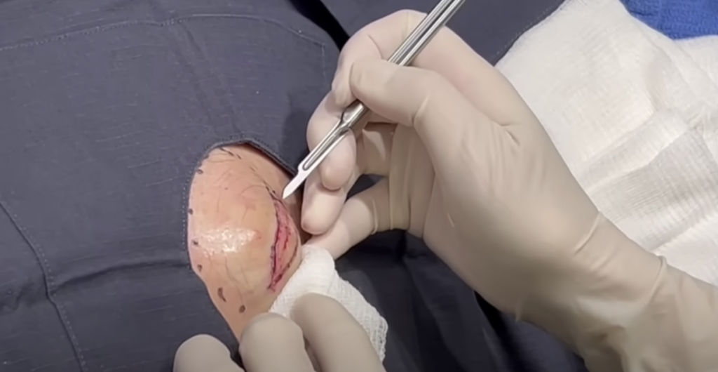 Dr Pimple Popper about to pop cyst